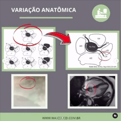 Variação anatômica RAC sign ecocardiograma wavesmed