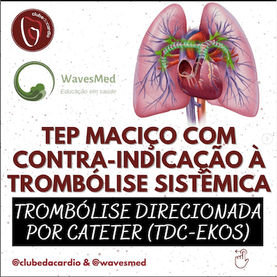 TEP Maciço Trombólise Wavesmed