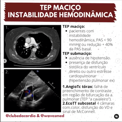 TEP Instabilidade Hemodinâmica TEP Maciço Trombólise Wavesmed