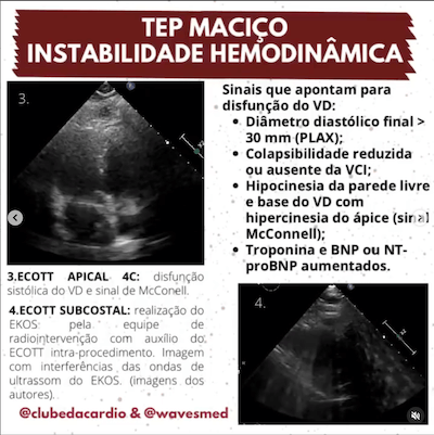 ECO TEP Maciço Trombólise Wavesmed