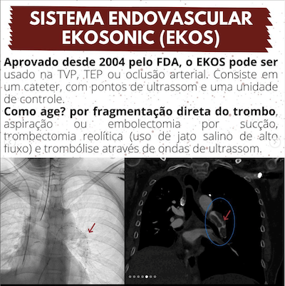 Sistema Endovascular TEP Macico Trombolise Wavesmed