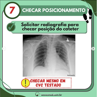 Checar 7 passos para passagem cateter venoso central Wavesmed