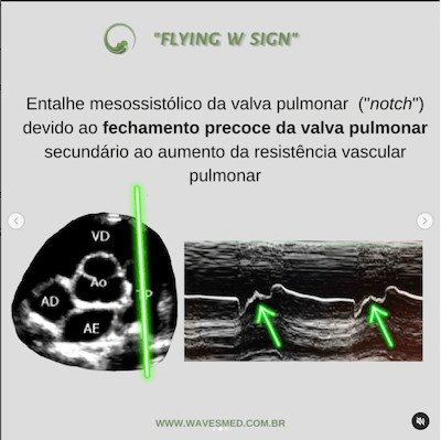 Valva pulmonar flying W sign Wavesmed