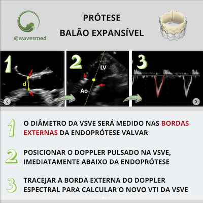 Prótese Balão expansível medida da vsve tavr Wavesmed