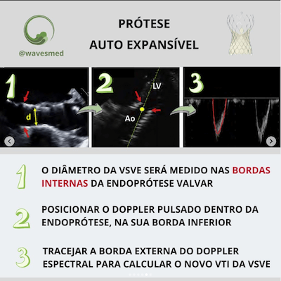 Prótese auto expansível medida da vsve tavr Wavesmed