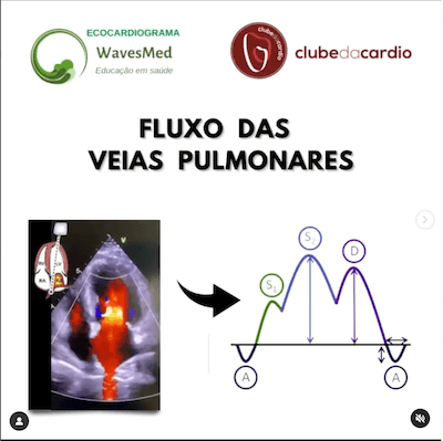 Ecocardiograma veias pulmonares wavesmed