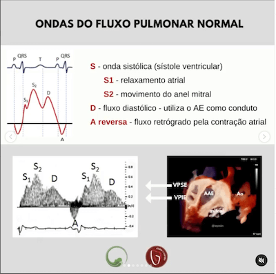 Ondas fluxo normal ecocardiograma veias pulmonares Wavesmed