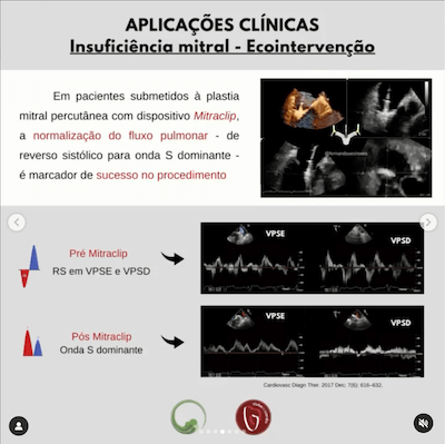 Eco intervenção ecocardiograma veias pulmonares Wavesmed