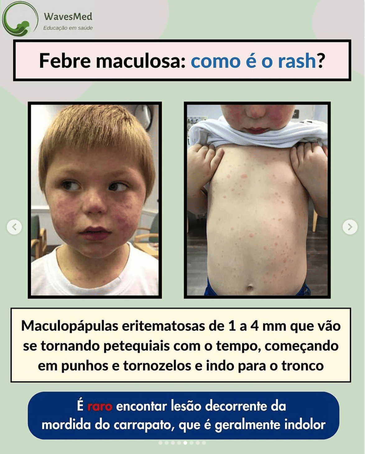 Febre_Maculosa_Rash
