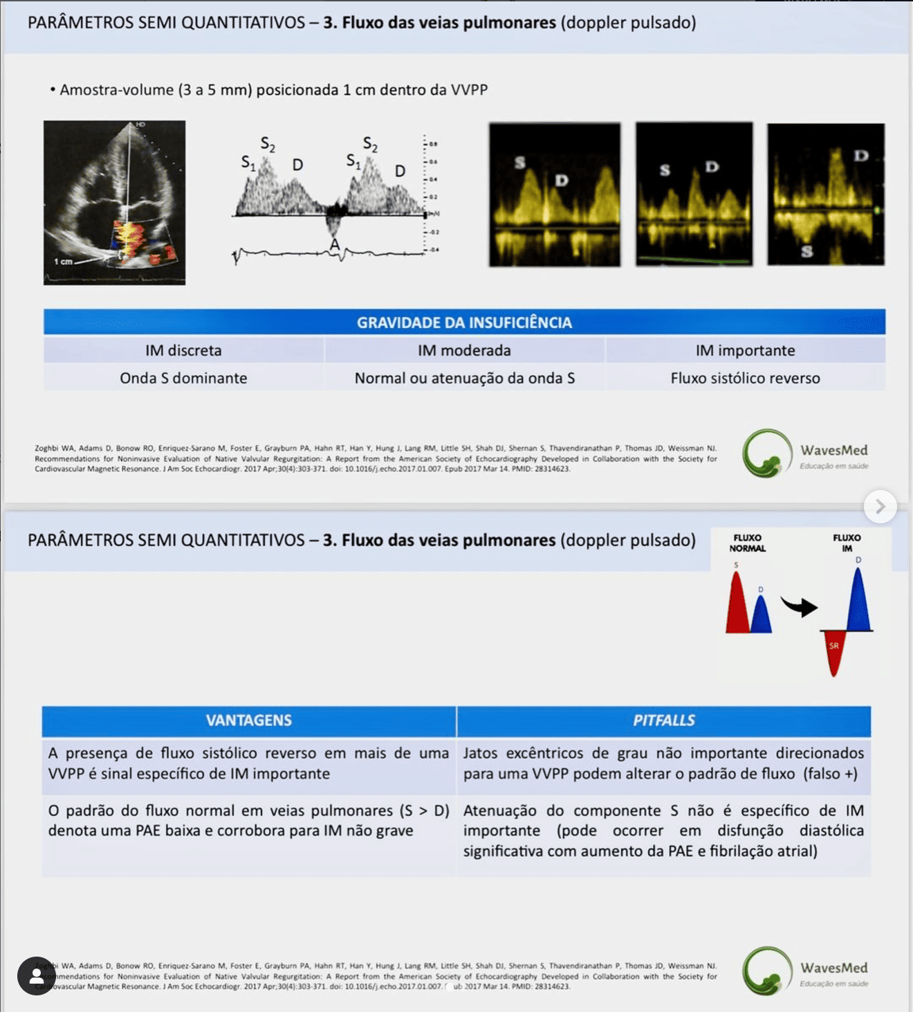 Avaliação Ecocardiográfica da Insuficiencia Mitral wavesmed
