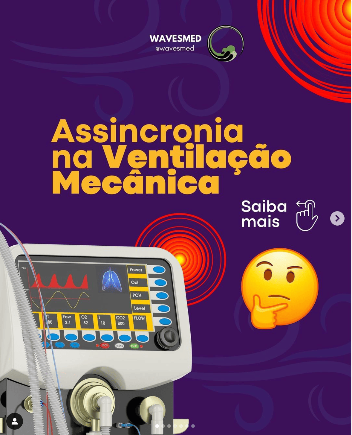 Assincronia na Ventilacao Mecanica Wavesmed