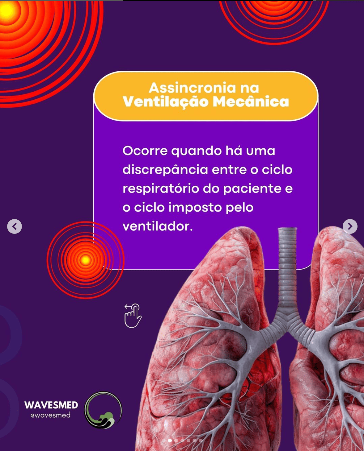Definicao Assincronia na Ventilacao Mecanica Wavesmed