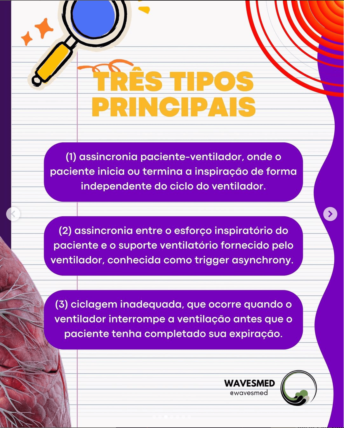 Tipos Assincronia na Ventilacao Mecanica Wavesmed