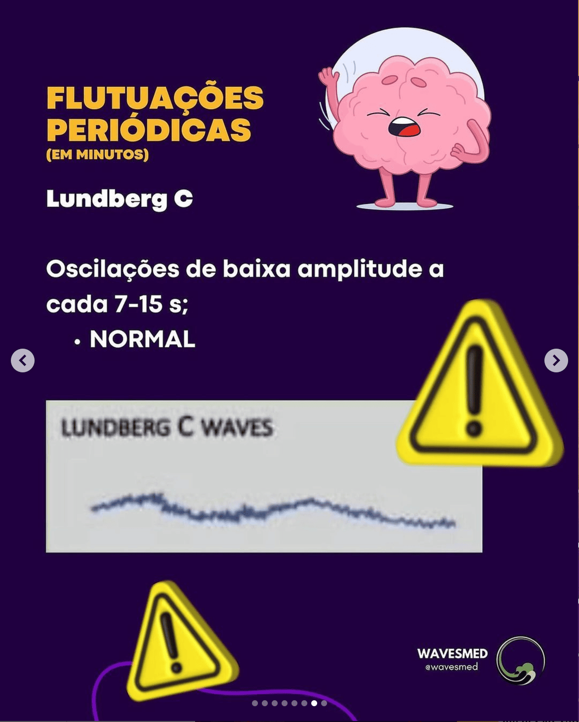 Lundberg c curva de pressão intracraniana Wavesmed