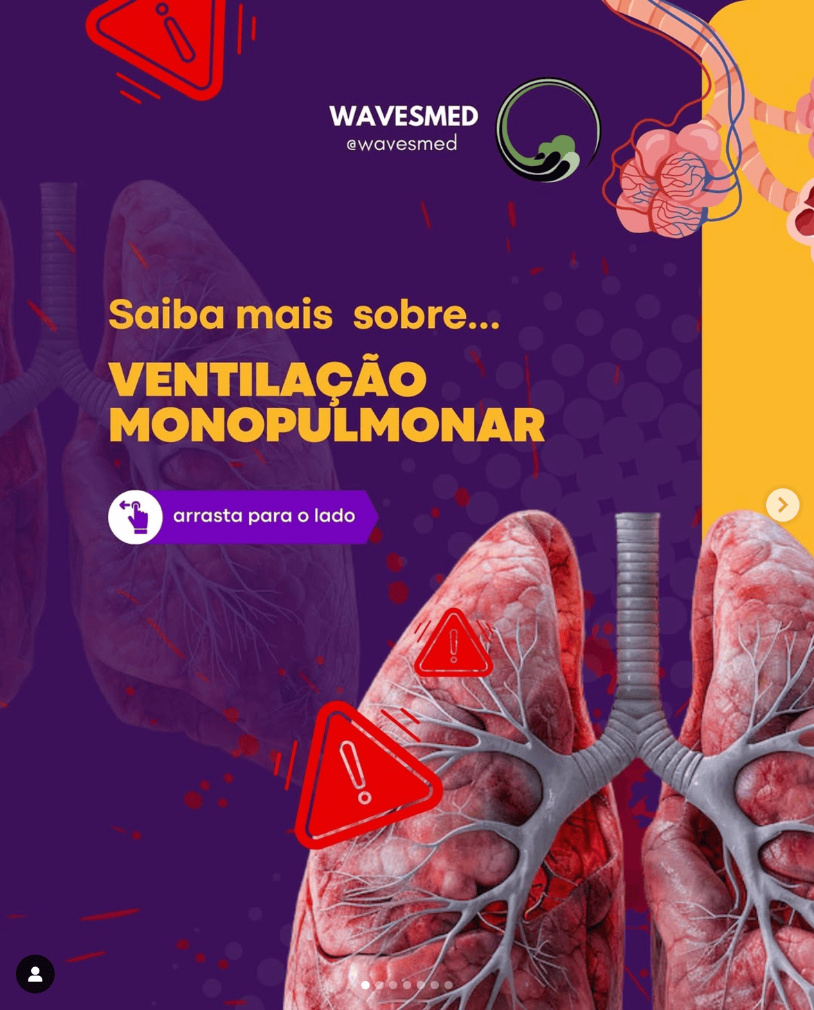 TEMI ventilação monopulmonar Wavesmed