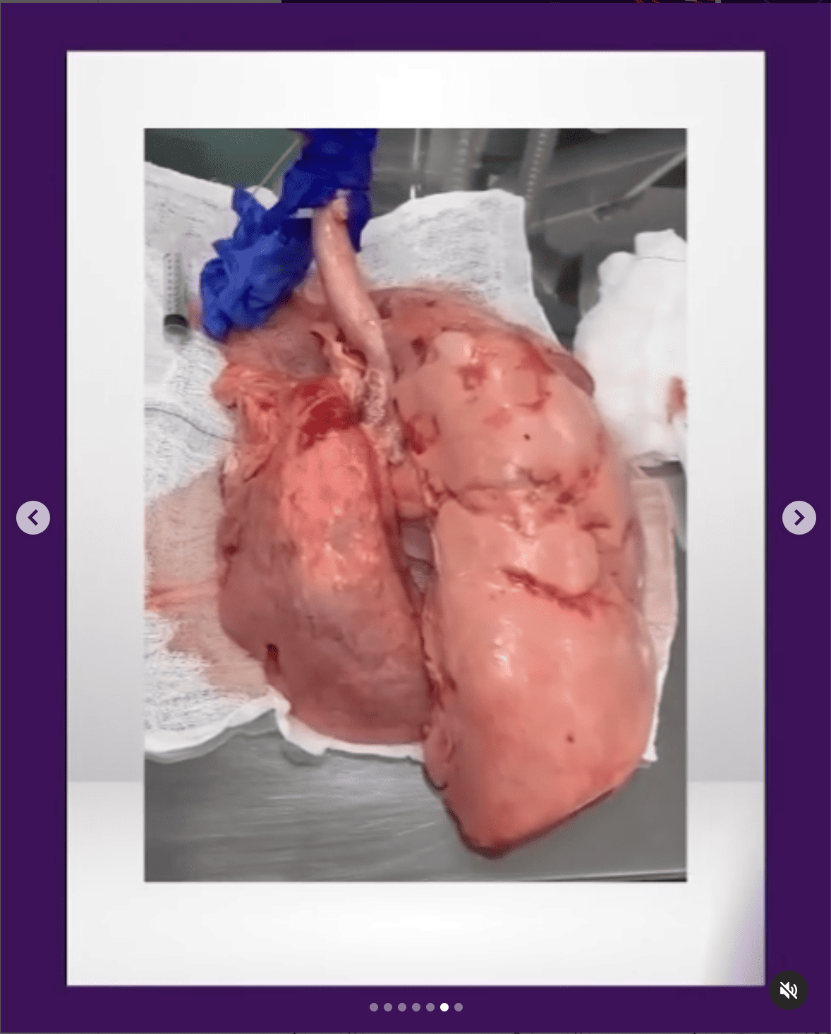 Ventilação monopulmonar Wavesmed TEMI