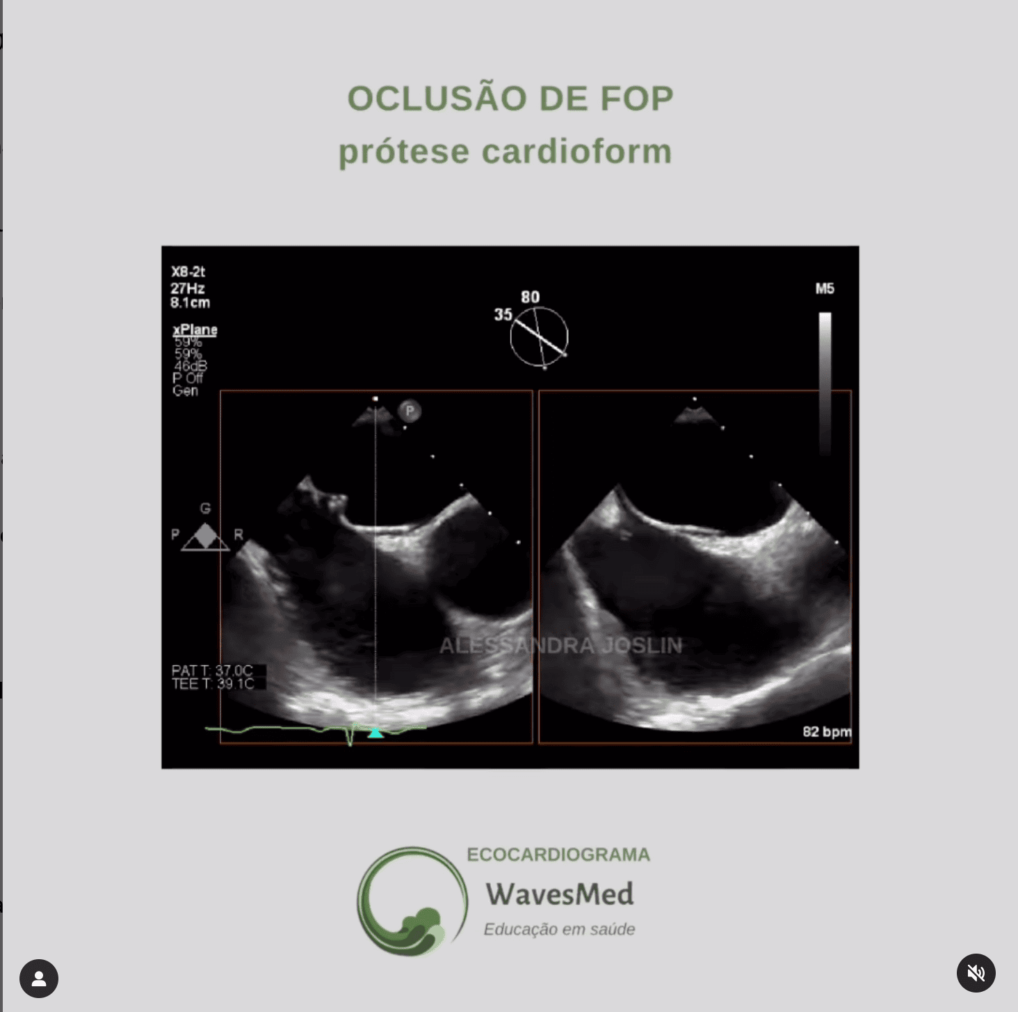 Oclusão Percutânea forame oval Wavesmed