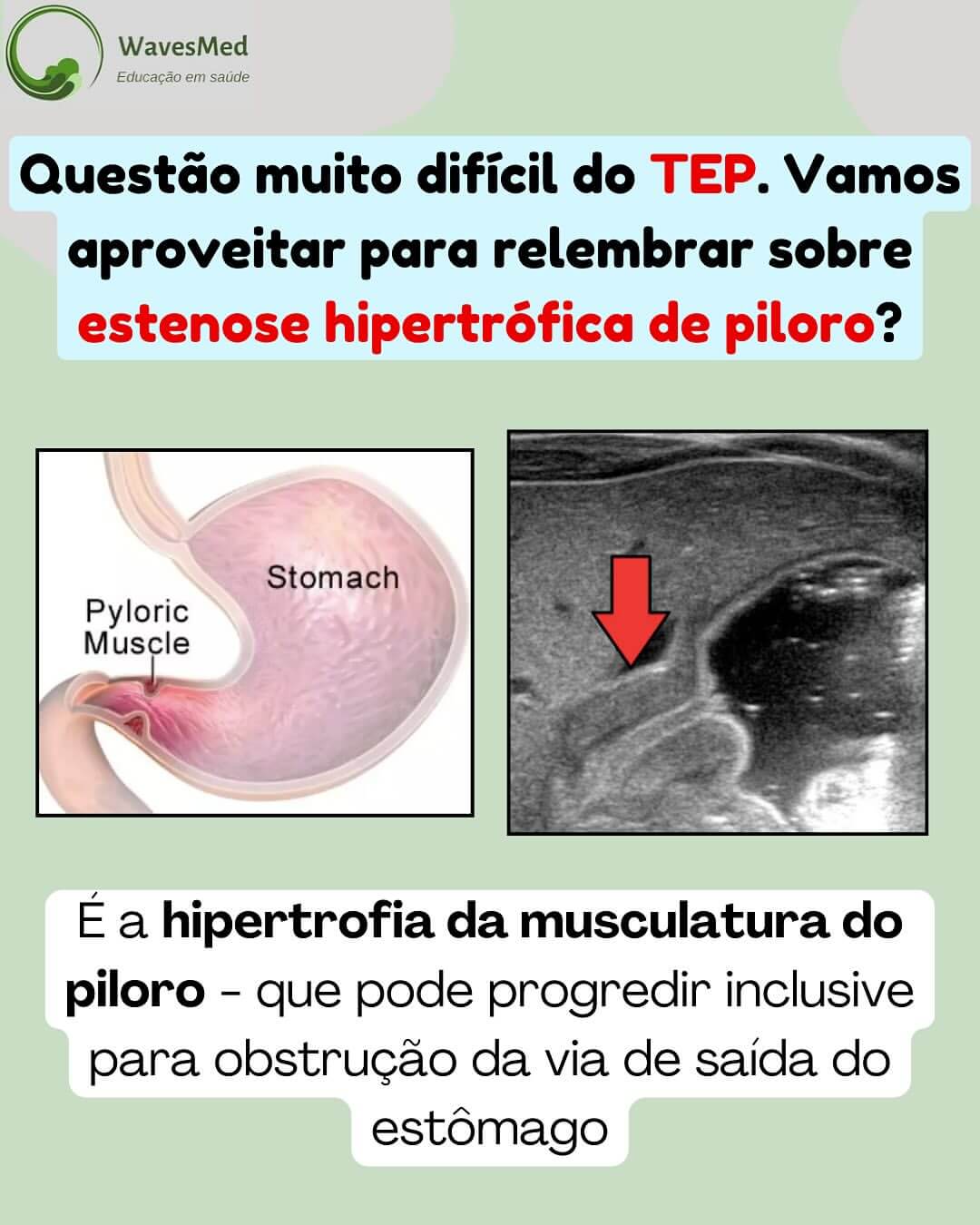 Questao tep estenose hipertrofica de piloro Wavesmed