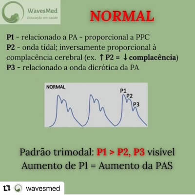 Curva de PIC normal Wavesmed