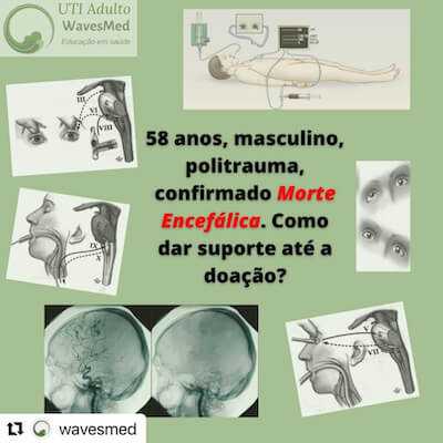 Morte encefálica: Como dar suporte até a doação?  Wavesmed