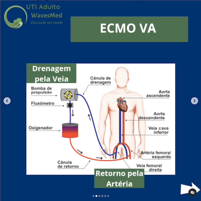 Tipo de ECMO Wavesmed  ECMO veno arterial