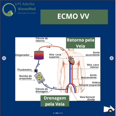 Tipo de ECMO Wavesmed  ECMO Veno-venosa