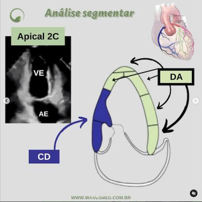 Função ventricular esquerda ecocardiograma  Análise coronária correspondente  Apical 2C