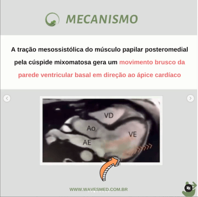 Pickelhaube Sign Wavesmed  Mecanismo