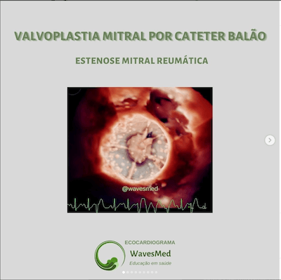 Valvoplastia mitral por cateter balão Wavesmed  Estenose mitral reumática