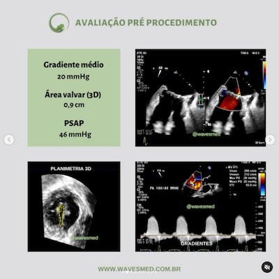 Avaliação pré procedimento  Valvoplastia mitral por cateter balão Wavesmed