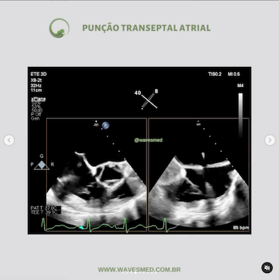 Punção transeptal atrial  Valvoplastia mitral por cateter balão Wavesmed