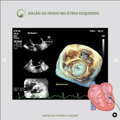 Balão de Inoue no átrio esquerdo  Valvoplastia mitral por cateter balão Wavesmed