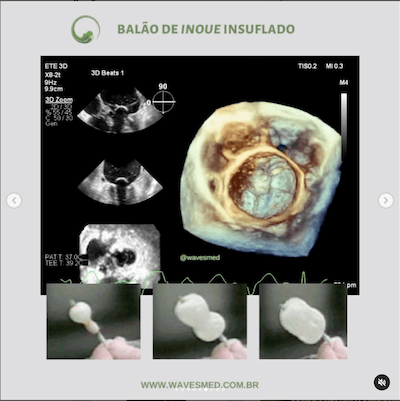 Balão Inoue insulflado  Valvoplastia mitral por cateter balão Wavesmed