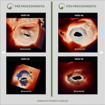 Pós valvoplastia  Valvoplastia mitral por cateter balão Wavesmed