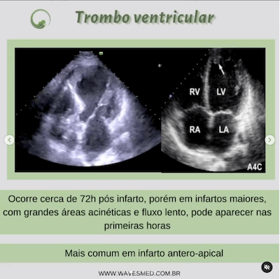 trombo ventricular  Complicações pós Infarto Agudo do Miocárdico Wavesmed