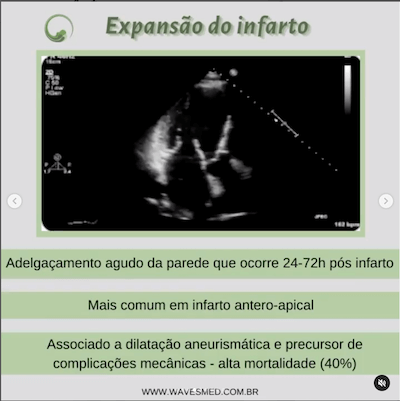 Expansao do Infarto  Complicações pós Infarto Agudo do Miocárdico Wavesmed