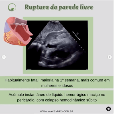Ruptura de parede livre  Complicações pós Infarto Agudo do Miocárdico Wavesmed