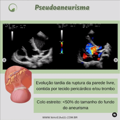 Pseudoaneurisma  Complicações pós Infarto Agudo do Miocárdico Wavesmed