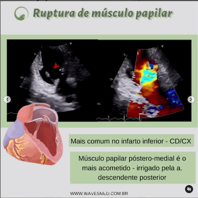 Ruptura de musculo papilar  Complicações pós Infarto Agudo do Miocárdico Wavesmed