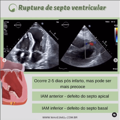 Ruptura do septo ventricular  Complicações pós Infarto Agudo do Miocárdico Wavesmed